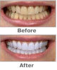 Home Laser Teeth Whitening Kit